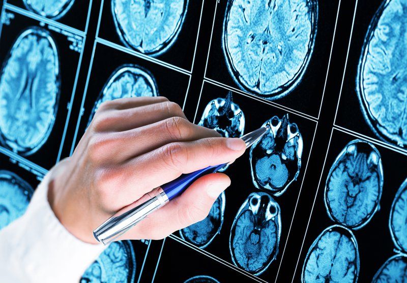 A hand holding a pen points to a specific area on a series of brain scan images displayed on a lightbox, highlighting changes often seen in vascular dementia—crucial information for caregivers.