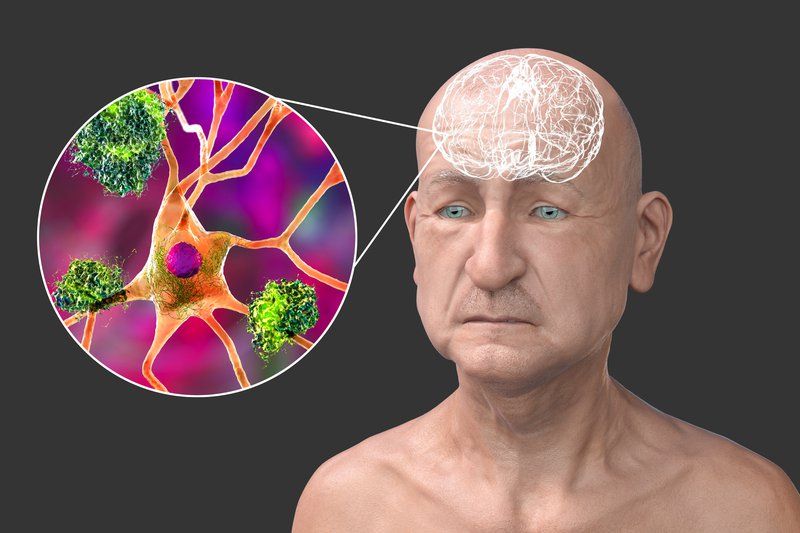 Illustration of an elderly man with a highlighted brain section showing neurons and amyloid plaques, representing Alzheimer's or Lewy Body Dementia neurodegenerative disease.