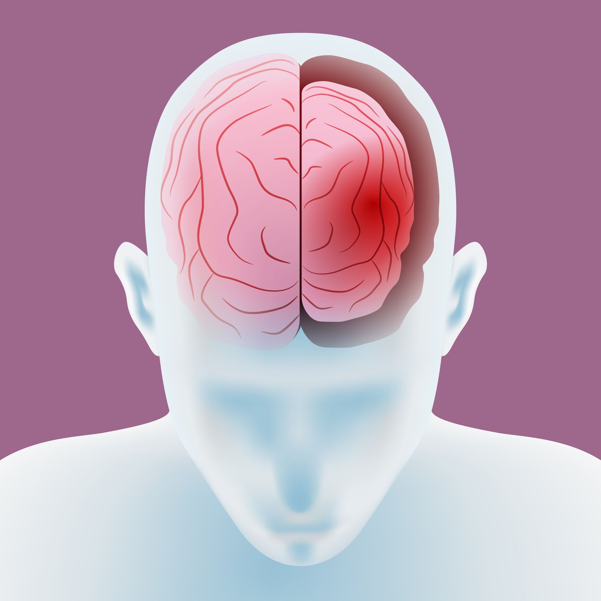 Illustration of a human head with a visible brain; the right side is highlighted in red, indicating an area of concern related to early onset dementia or juvenile dementia.